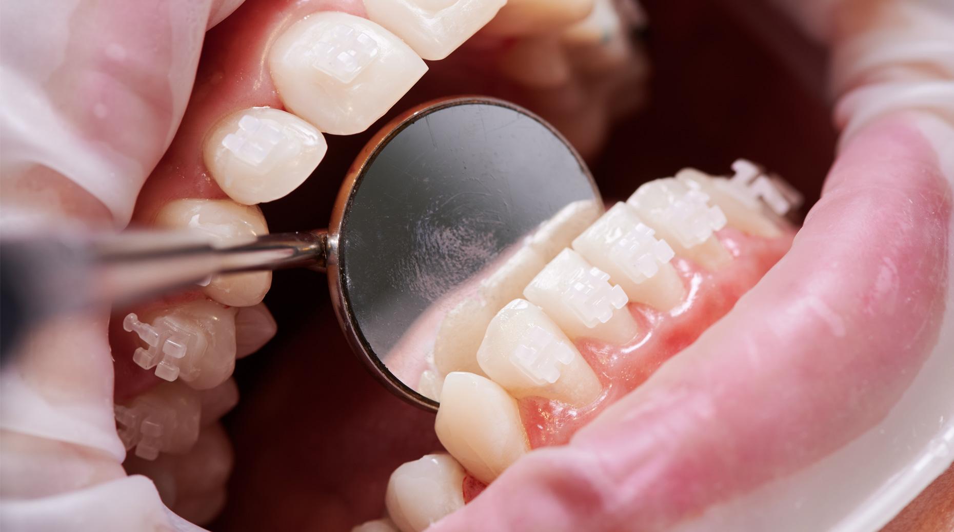 Santé : Des dentistes alertent sur le "désengagement" de la Sécu